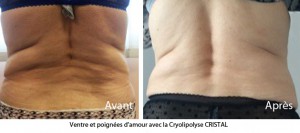 Cryolipolyse Cristal Paris avant apres liposuccion sans chirurgie